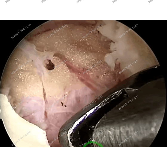 UBE-UBE-Keyhole Anatomical Layers (High Definition) AYDEFY